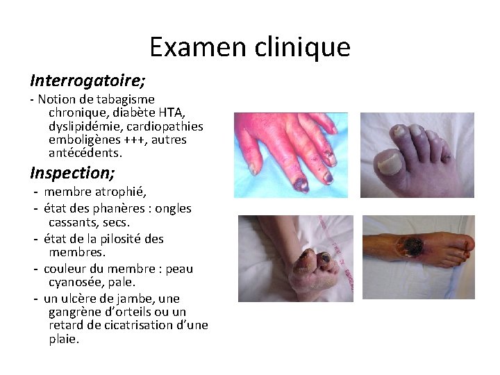 Examen clinique Interrogatoire; - Notion de tabagisme chronique, diabète HTA, dyslipidémie, cardiopathies emboligènes +++,