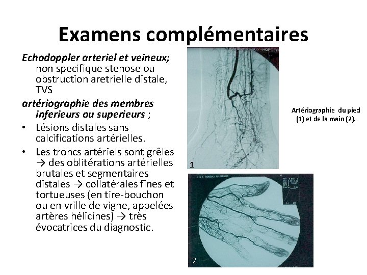 Examens complémentaires Echodoppler arteriel et veineux; non specifique stenose ou obstruction aretrielle distale, TVS