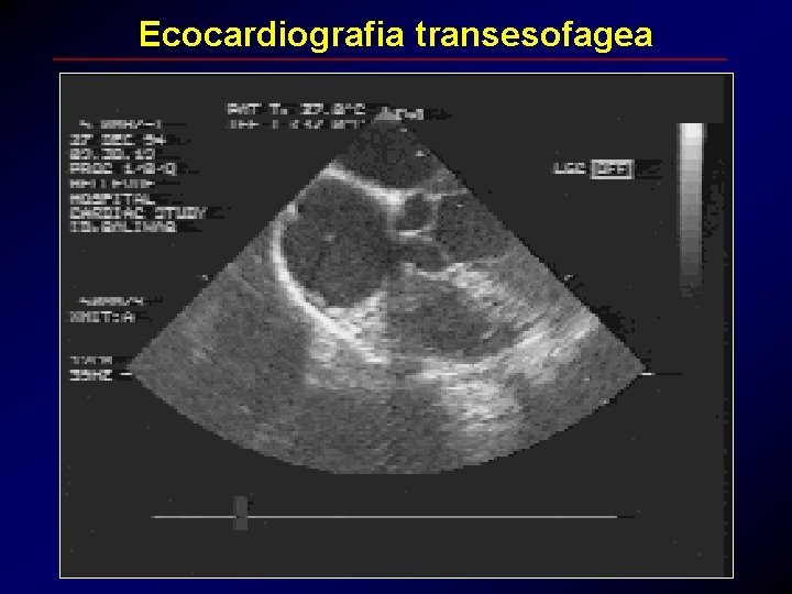 Ecocardiografia transesofagea 