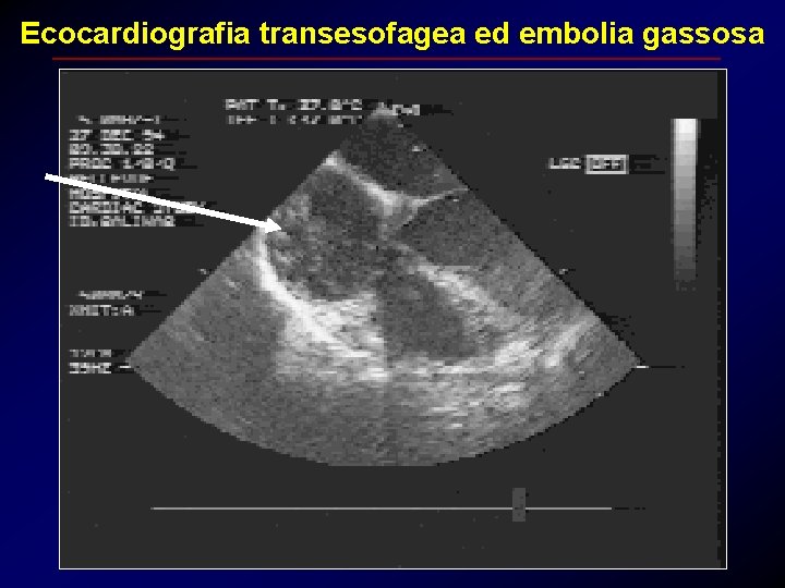 Ecocardiografia transesofagea ed embolia gassosa 