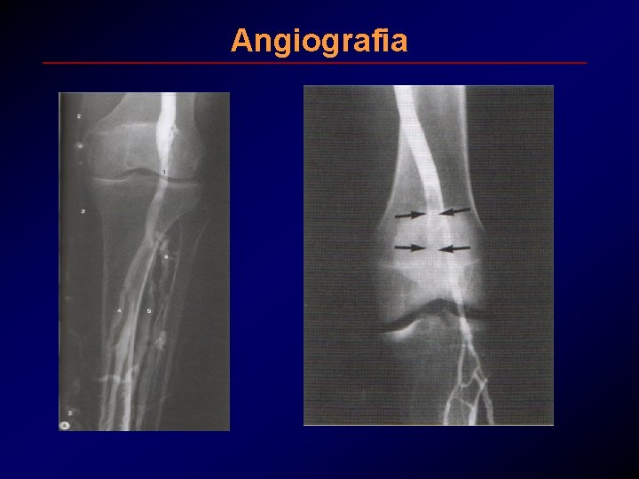 Angiografia 