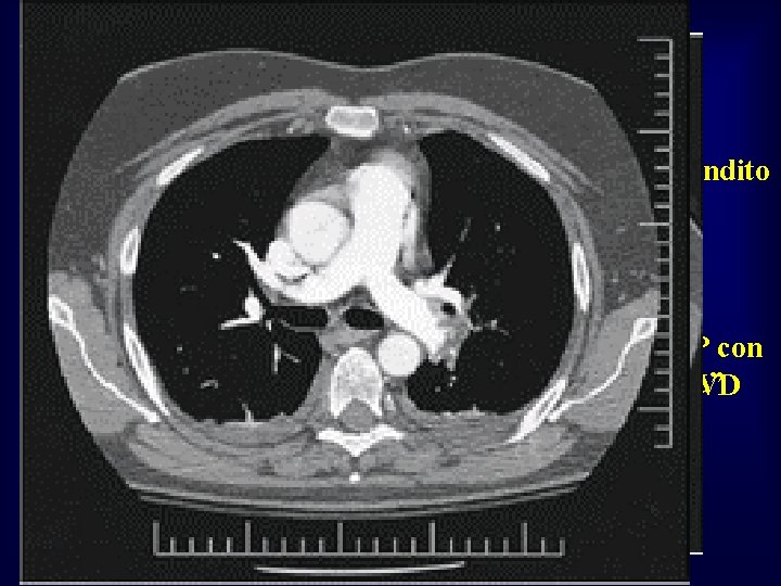  • • donna di 29 anni A) prima della trombolisi: VD ingrandito e