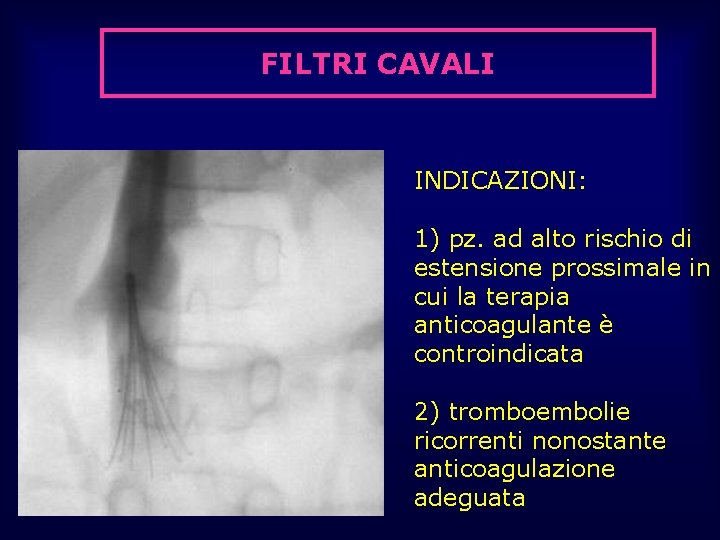 FILTRI CAVALI INDICAZIONI: 1) pz. ad alto rischio di estensione prossimale in cui la