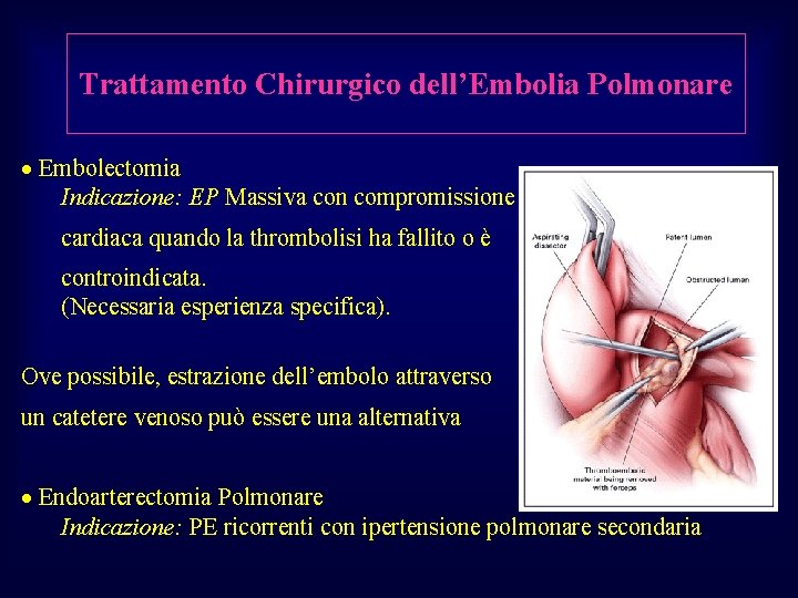 Trattamento Chirurgico dell’Embolia Polmonare · Embolectomia Indicazione: EP Massiva con compromissione cardiaca quando la