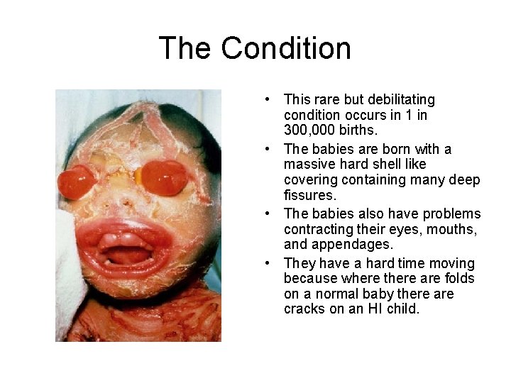 The Condition • This rare but debilitating condition occurs in 1 in 300, 000