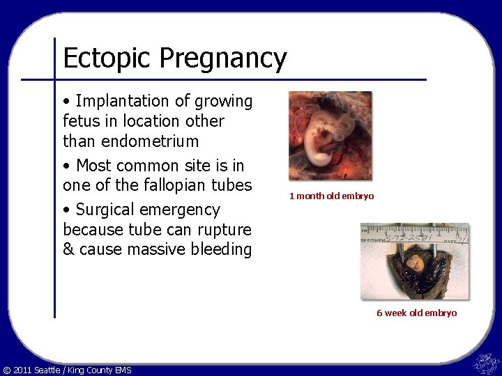 Ectopic Pregnancy • Implantation of growing fetus in location other than endometrium • Most
