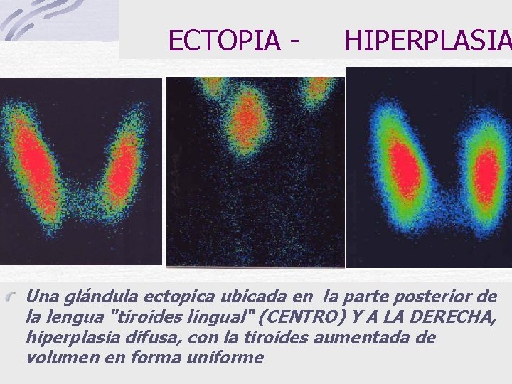 ECTOPIA - HIPERPLASIA Una glándula ectopica ubicada en la parte posterior de la lengua