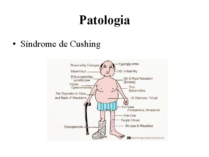 Patologia • Síndrome de Cushing 