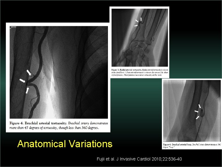 Anatomical Variations Fujii et al. J Invasive Cardiol 2010; 22: 536 -40 