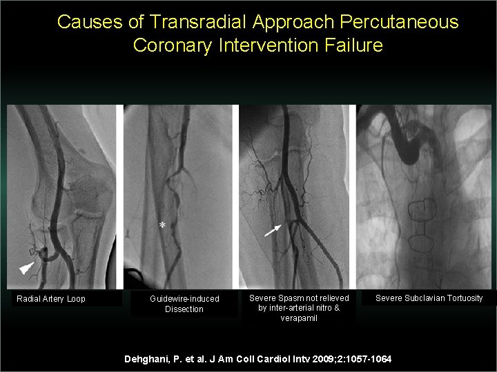 Causes of Transradial Approach Percutaneous Coronary Intervention Failure Radial Artery Loop Guidewire-induced Dissection Severe