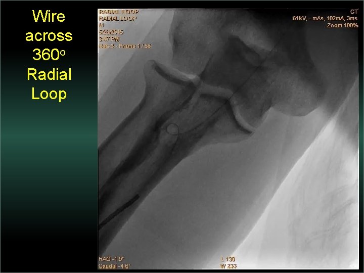 Wire across 360 o Radial Loop 