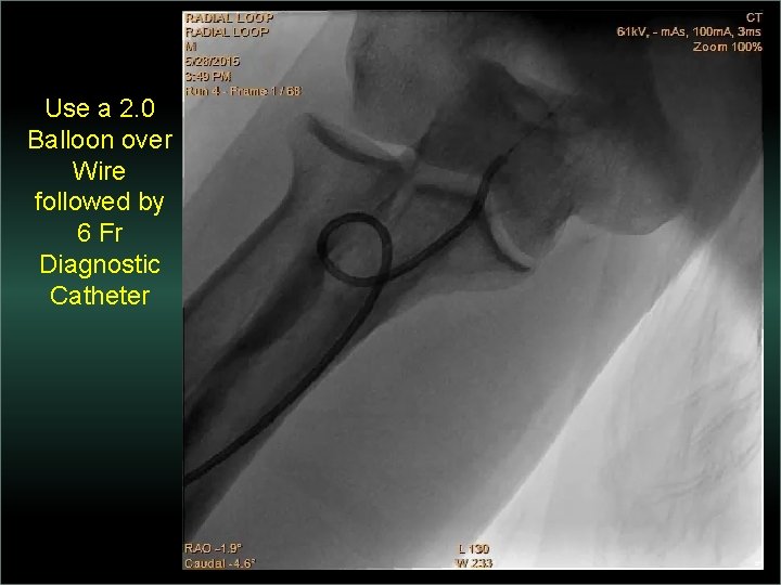 Use a 2. 0 Balloon over Wire followed by 6 Fr Diagnostic Catheter 