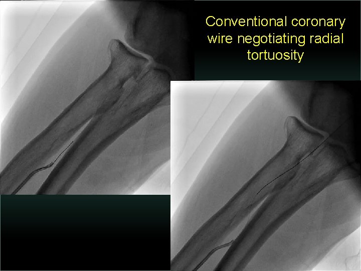 Conventional coronary wire negotiating radial tortuosity 