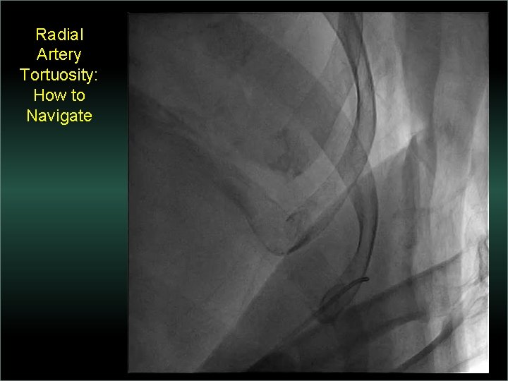 Radial Artery Tortuosity: How to Navigate 