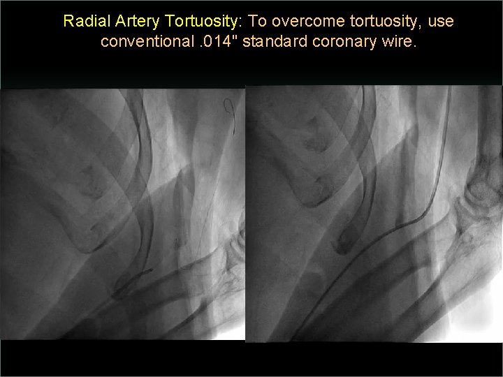 Radial Artery Tortuosity: To overcome tortuosity, use conventional. 014" standard coronary wire. 
