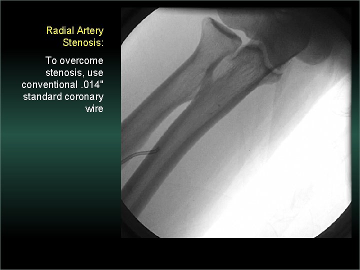 Radial Artery Stenosis: To overcome stenosis, use conventional. 014" standard coronary wire 