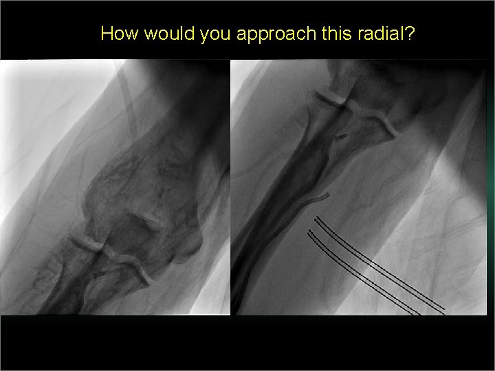 How would you approach this radial? 