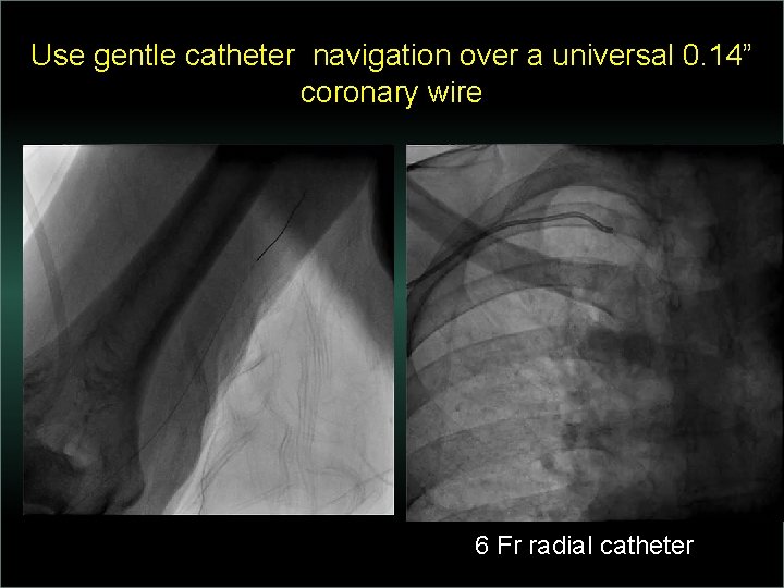 Use gentle catheter navigation over a universal 0. 14” coronary wire 6 Fr radial