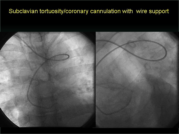 Subclavian tortuosity/coronary cannulation with wire support 