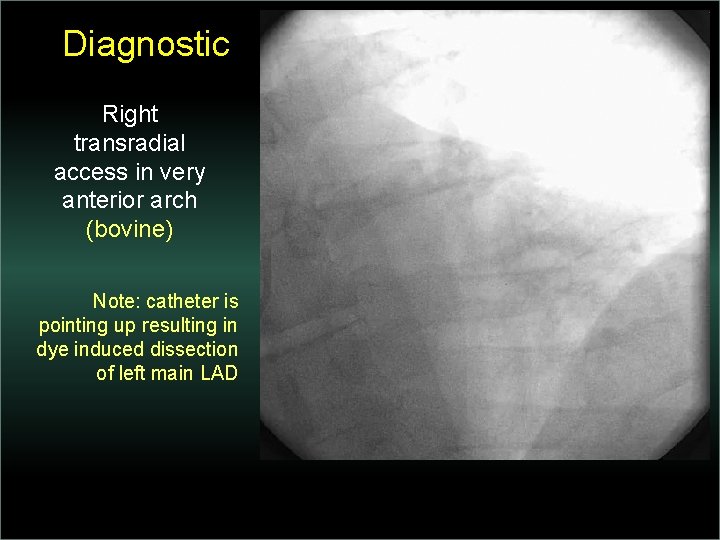 Diagnostic Right transradial access in very anterior arch (bovine) Note: catheter is pointing up