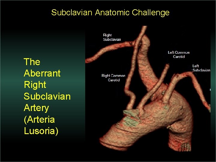 Subclavian Anatomic Challenge The Aberrant Right Subclavian Artery (Arteria Lusoria) 