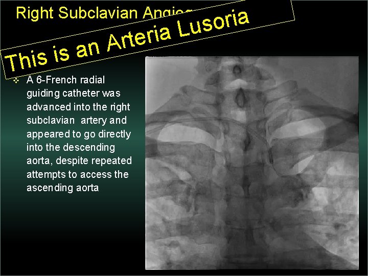 Right Subclavian Angiographyia n a s i This v r o s u L