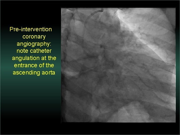 Pre-intervention coronary angiography: note catheter angulation at the entrance of the ascending aorta 