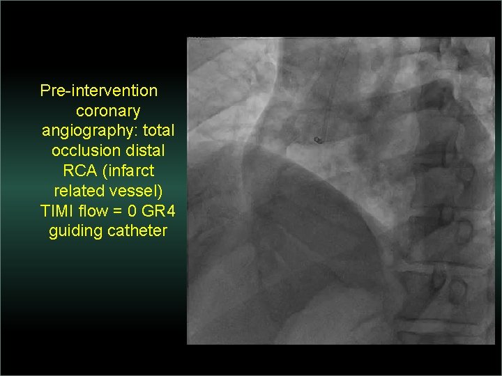 Pre-intervention coronary angiography: total occlusion distal RCA (infarct related vessel) TIMI flow = 0