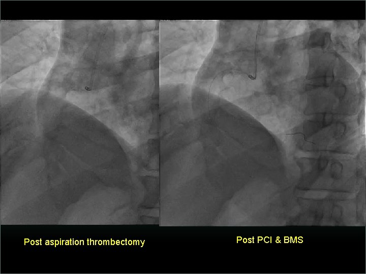 Post aspiration thrombectomy Post PCI & BMS 