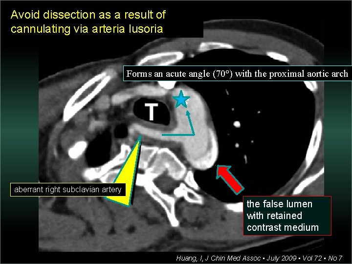 Avoid dissection as a result of cannulating via arteria lusoria Forms an acute angle