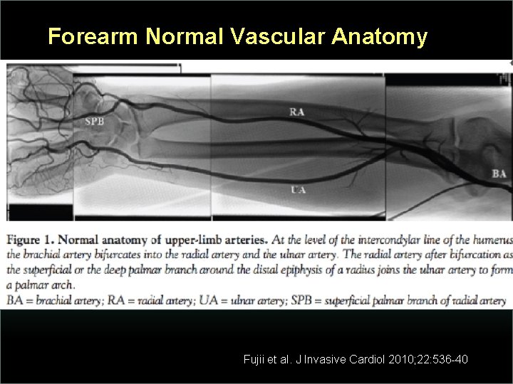 Forearm Normal Vascular Anatomy Fujii et al. J Invasive Cardiol 2010; 22: 536 -40