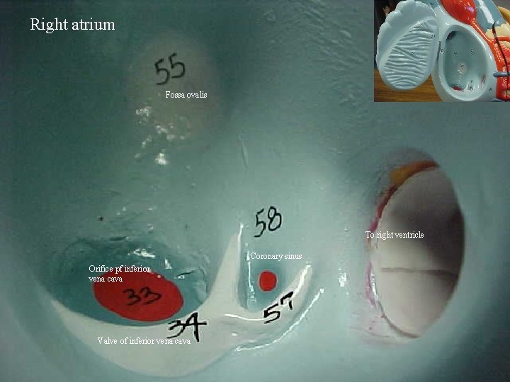 Right atrium Fossa ovalis To right ventricle Coronary sinus Orifice pf inferior vena cava