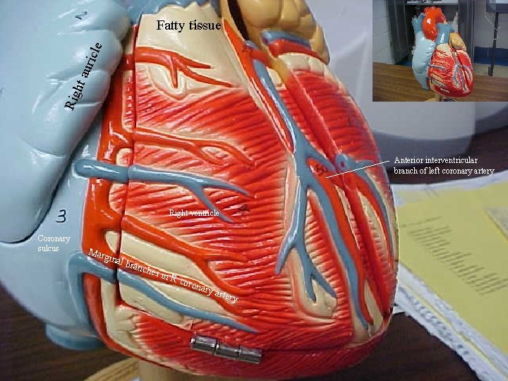 Rig ht a uric l e Fatty tissue Anterior interventricular branch of left coronary