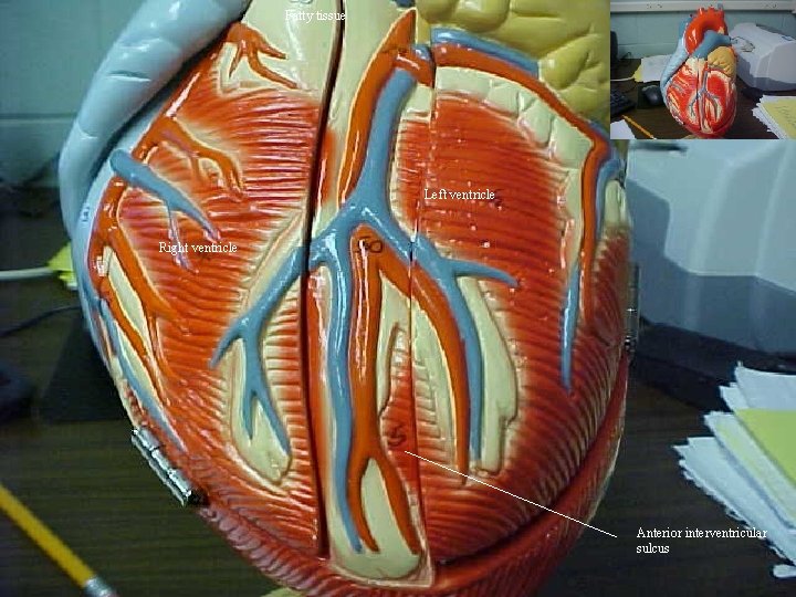 Fatty tissue Left ventricle Right ventricle Anterior interventricular sulcus 