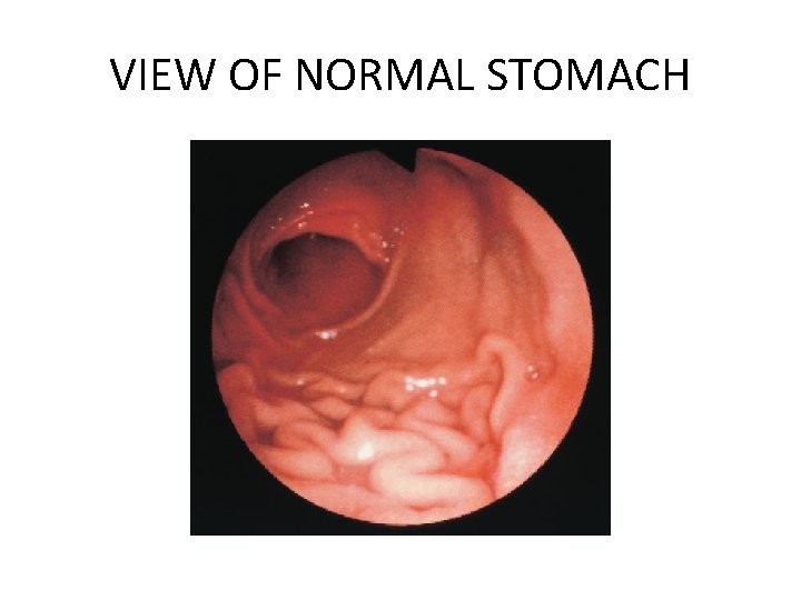VIEW OF NORMAL STOMACH 