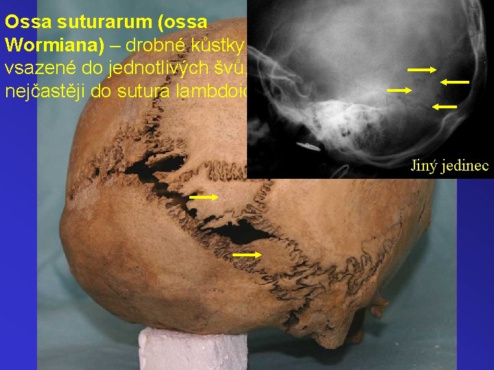 Ossa suturarum (ossa Wormiana) – drobné kůstky vsazené do jednotlivých švů, nejčastěji do sutura