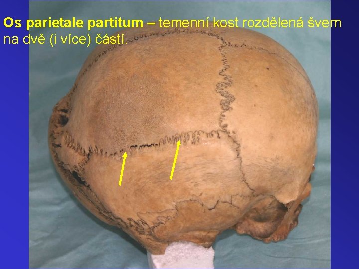 Os parietale partitum – temenní kost rozdělená švem na dvě (i více) částí. 
