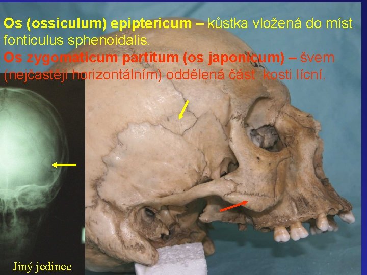 Os (ossiculum) epiptericum – kůstka vložená do míst fonticulus sphenoidalis. Os zygomaticum partitum (os