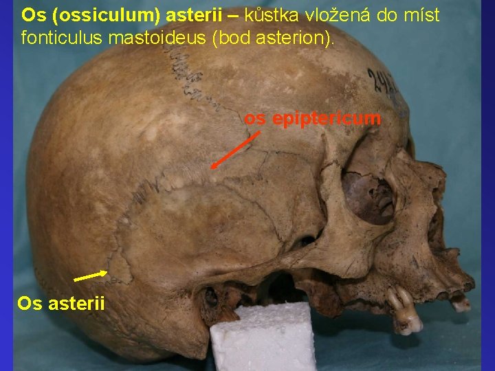 Os (ossiculum) asterii – kůstka vložená do míst fonticulus mastoideus (bod asterion). os epiptericum
