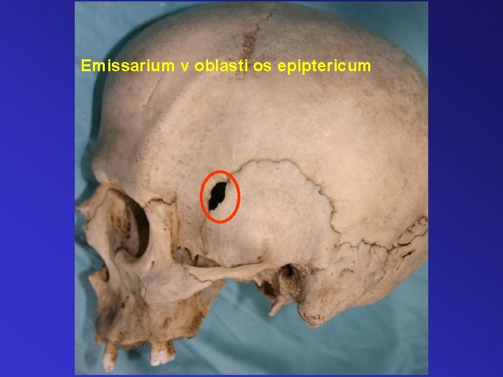 Emissarium v oblasti os epiptericum 