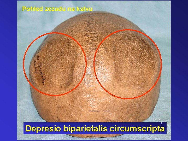 Pohled zezadu na kalvu Depresio biparietalis circumscripta 