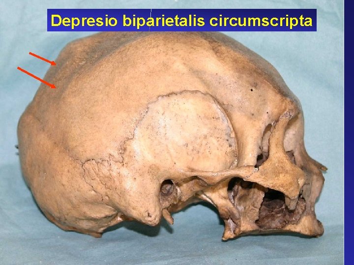 Depresio biparietalis circumscripta 