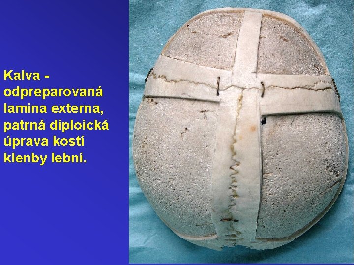 Kalva odpreparovaná lamina externa, patrná diploická úprava kostí klenby lební. 