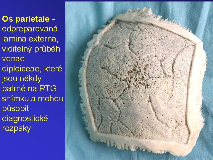 Os parietale odpreparovaná lamina externa, viditelný průběh venae diploiceae, které jsou někdy patrné na