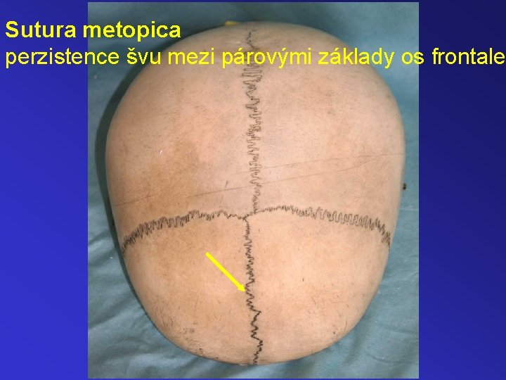 Sutura metopica perzistence švu mezi párovými základy os frontale 