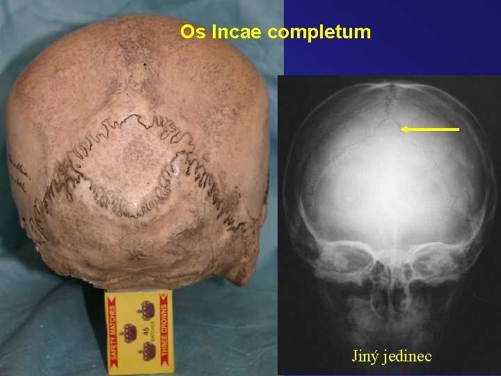 Os Incae completum Jiný jedinec 