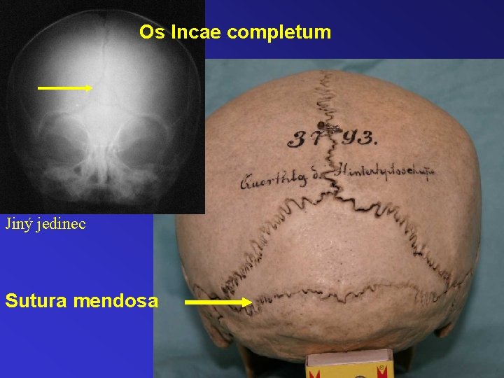 Os Incae completum Jiný jedinec Sutura mendosa 