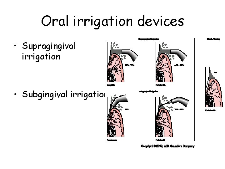 Oral irrigation devices • Supragingival irrigation • Subgingival irrigation 