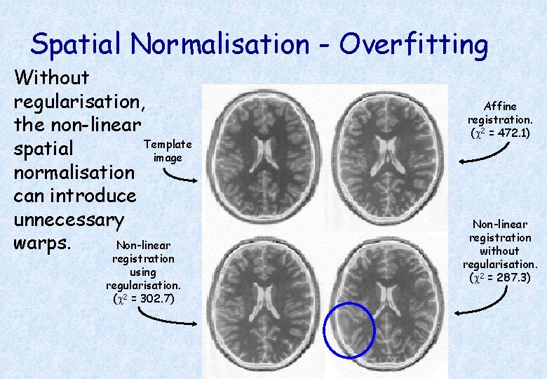 Spatial Normalisation - Overfitting Without regularisation, the non-linear Template spatial image normalisation can introduce