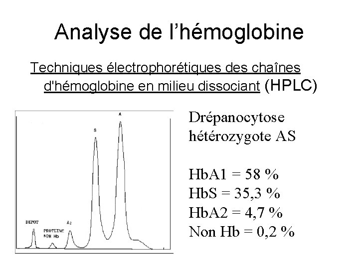 Analyse de l’hémoglobine Techniques électrophorétiques des chaînes d'hémoglobine en milieu dissociant (HPLC) Drépanocytose hétérozygote